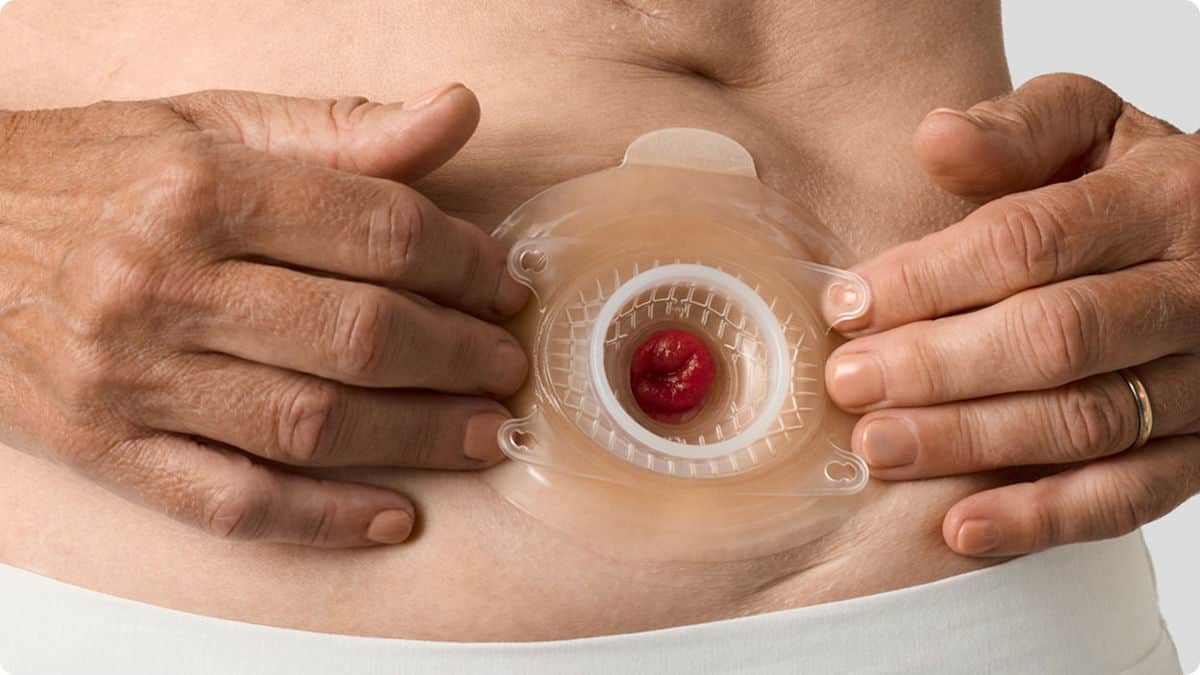 Des mains placent une plaque de base convexe sur une urostomie au niveau de l'abdomen
