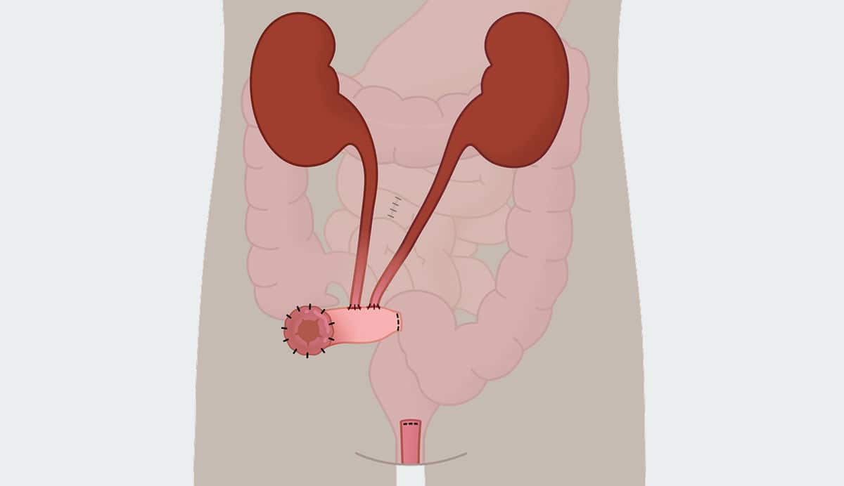 Illustration d'un corps humain montrant la structure d'une urostomie