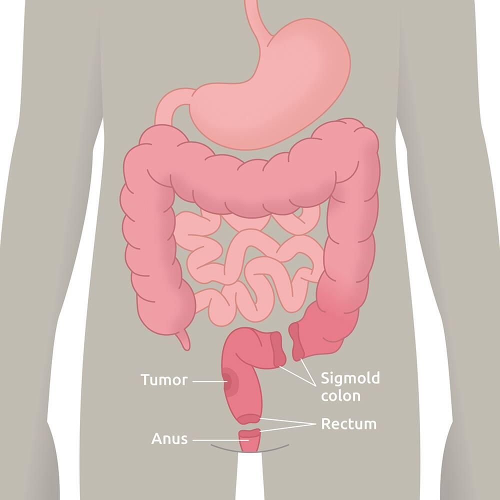 Low anterior resection syndrom (LARS)