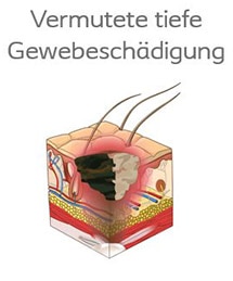 Dekubitus vermutete Gewebeschädigung