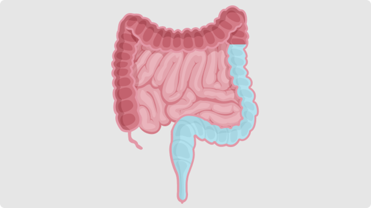 Was ist die hochvolumige TAI? (Transanale Irrigation)