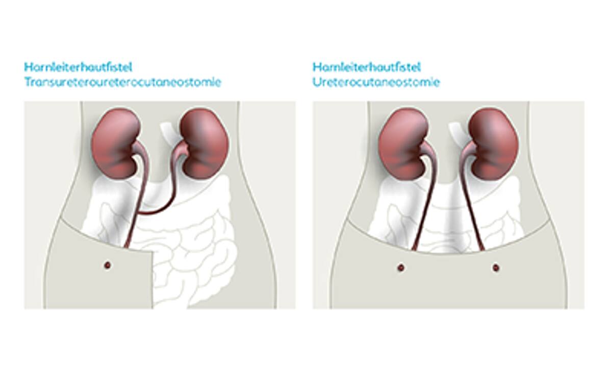Illustration eines Harnleiterhautfistel mit Beschriftungen