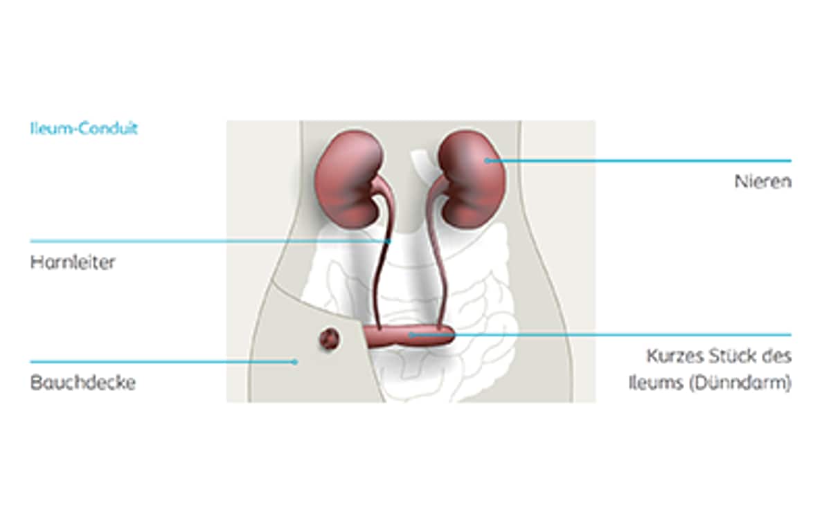 Illustration eines Ileum-Conduits mit Beschriftungen