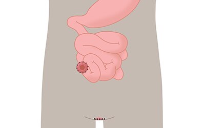 Endständige Ileostomie