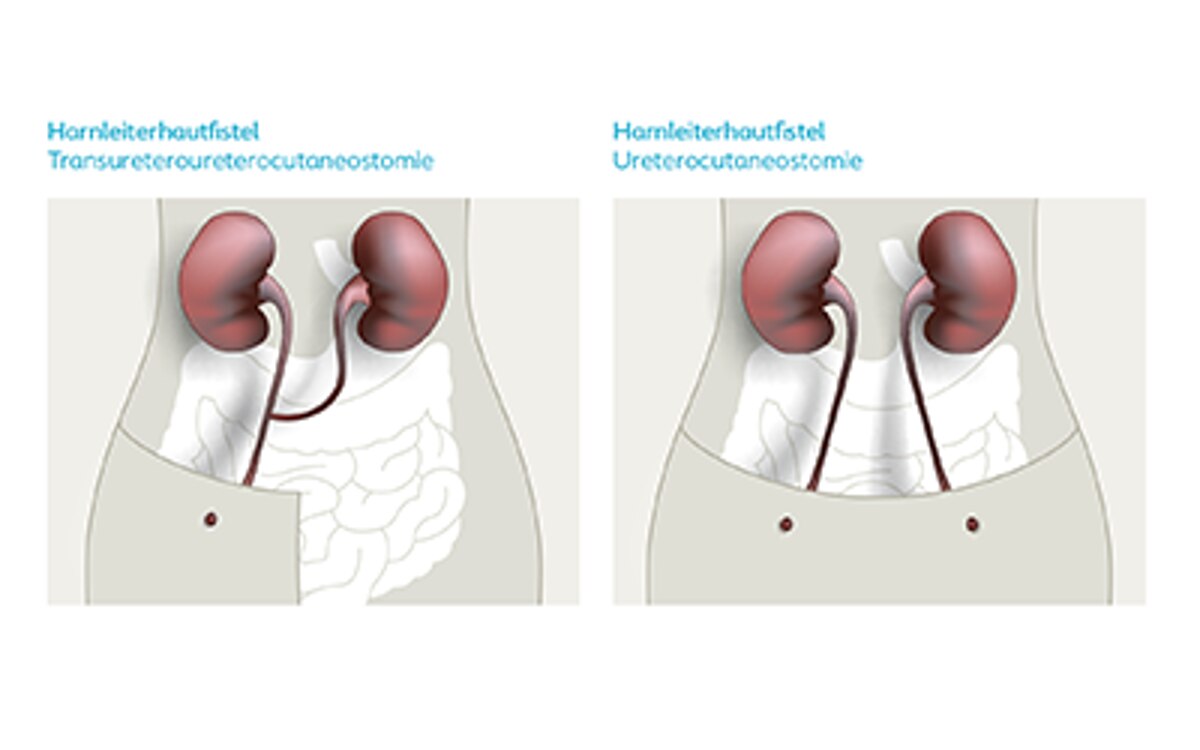 Illustration eines Harnleiterhautfistel mit Beschriftungen