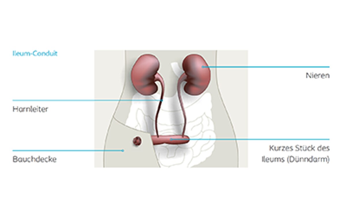 Illustration eines Ileum-Conduits mit Beschriftungen