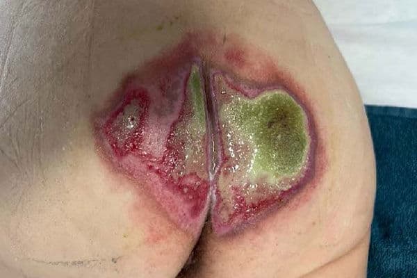 Fallverlauf Dekubitus nach Bypass-OP: Tag 0
