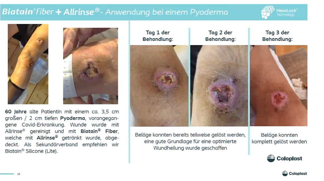 Der Faserverband - mehr als nur ein Wundfüller