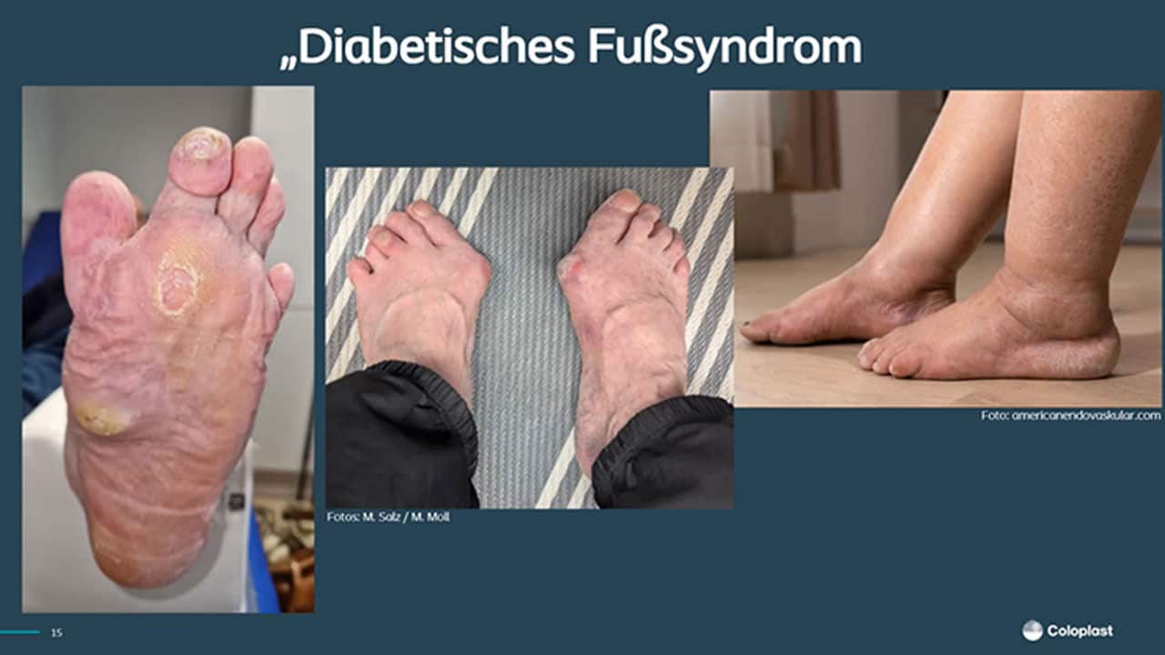 Das diabetische Fusssyndrom