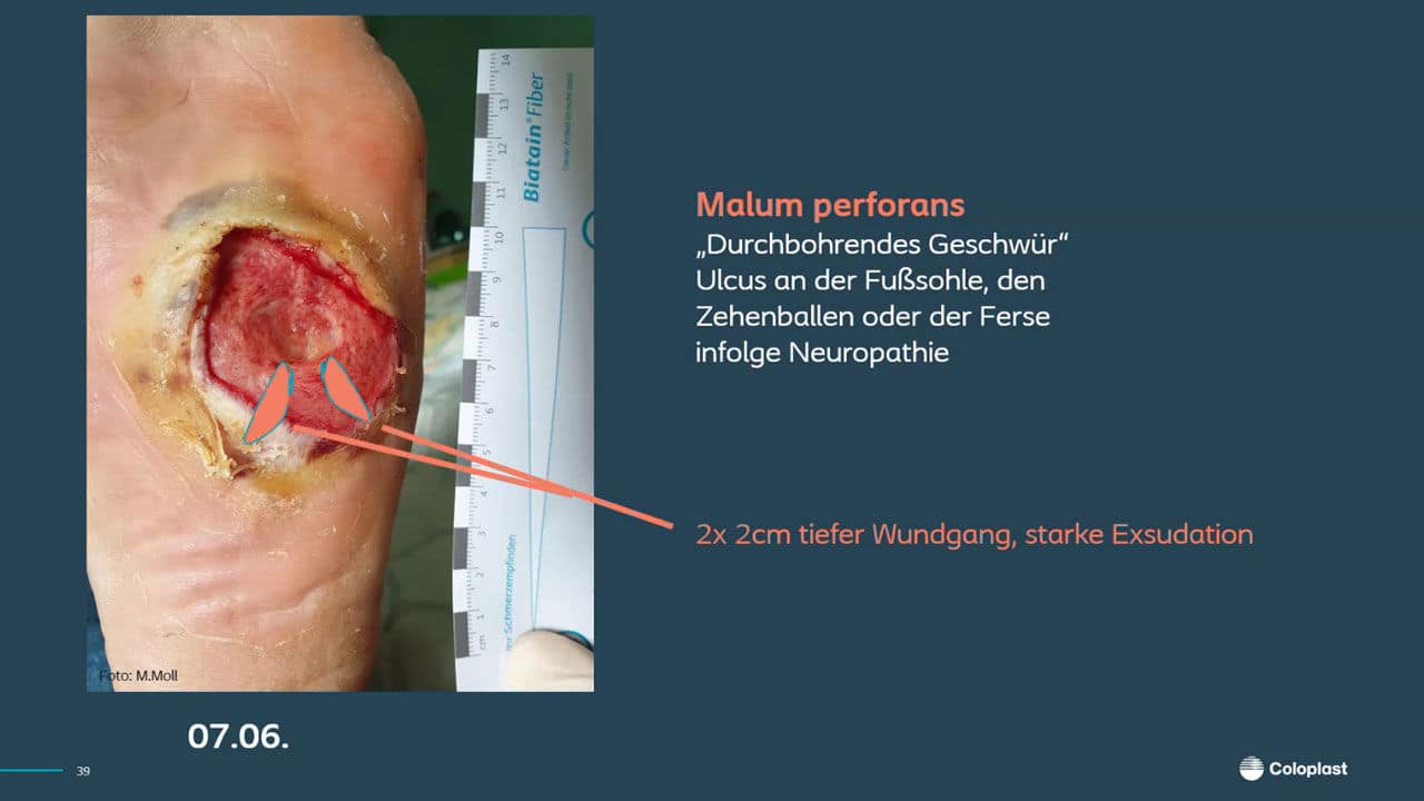 Teaser: Das diabetische Fusssyndrom