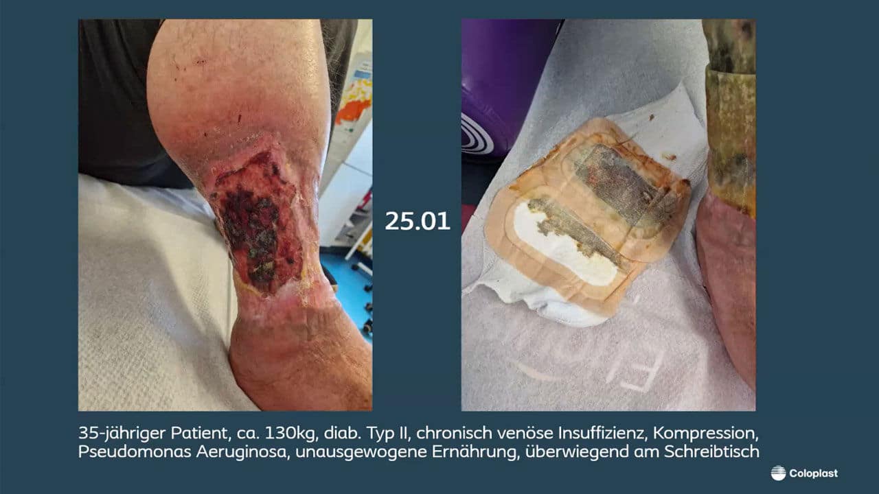 Teaser: Was ist los auf der Wunde? Wie erkenne ich Biofilm & co.?